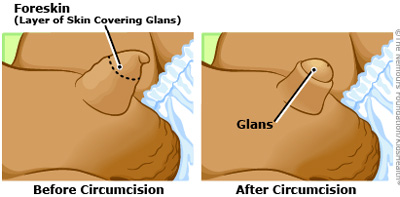 Before/AFter Circumcision illustration